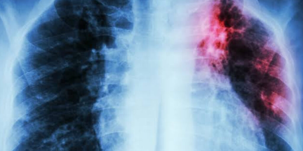 Tuberculosis Cases in England Rise by 11% in 2023