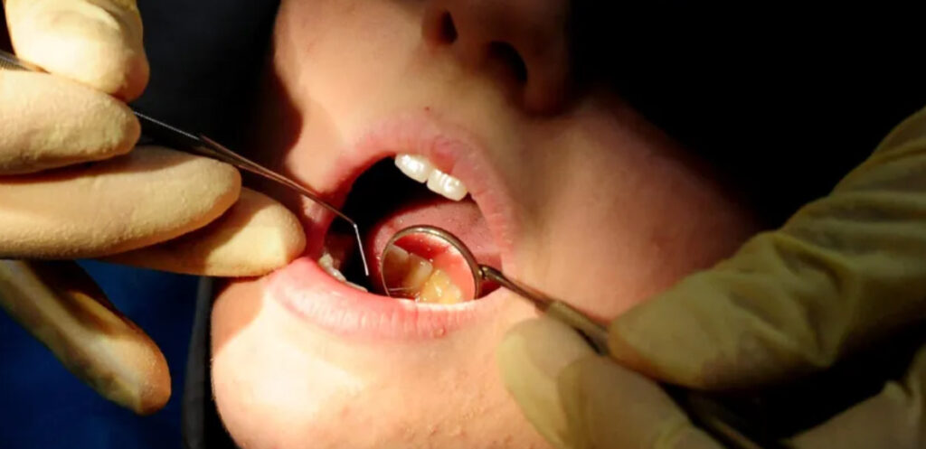 14 Million Adults Unable to Access NHS Dental Care in England 14 Million Adults Unable to Access NHS Dental Care in England
