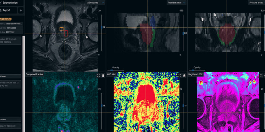NHS Expands AI Prostate Cancer Diagnosis Across England NHS Expands AI Prostate Cancer Diagnosis Across England